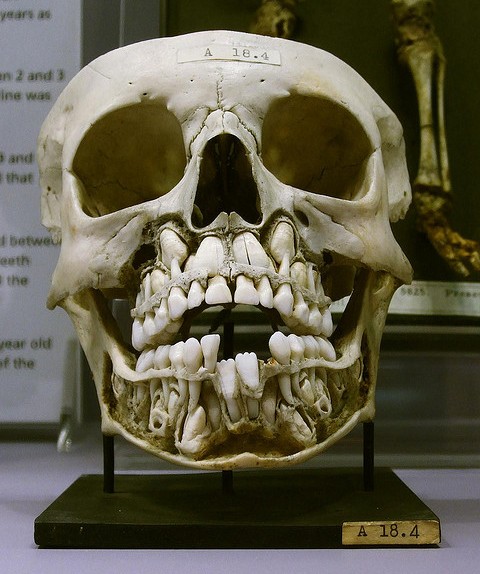 Name:  Skull-of-a-child-growing-adult-teeth.jpg
Views: 1896
Size:  79.4 KB