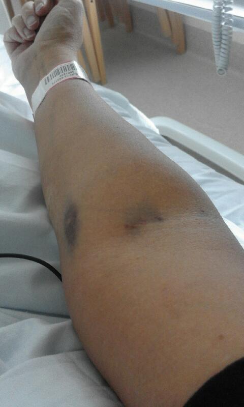 Name:  Bruise 1.jpeg
Views: 305
Size:  34.1 KB