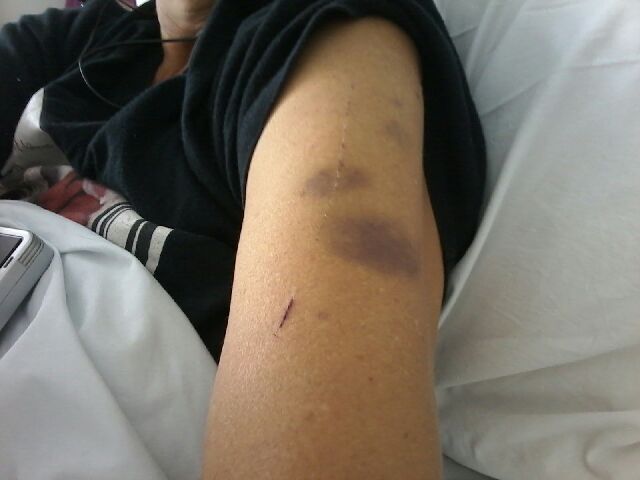 Name:  Bruise 2.jpeg
Views: 306
Size:  29.7 KB