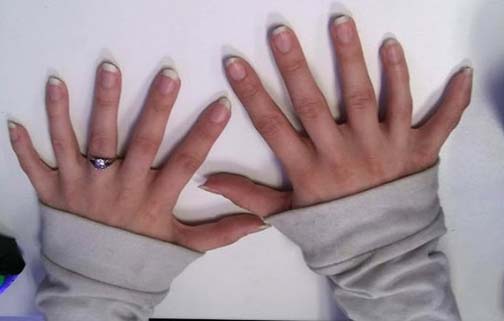 Name:  Polydactyly.jpg
Views: 1070
Size:  18.4 KB