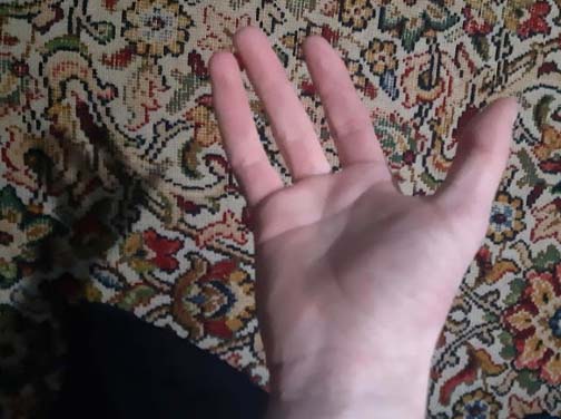 Name:  oligodactyly.jpg
Views: 728
Size:  38.5 KB