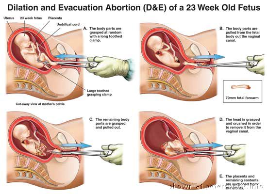 Name:  abortion.jpg
Views: 39303
Size:  46.9 KB